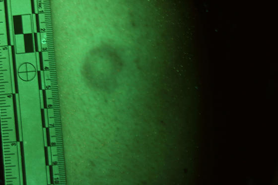 Human skin in closeup with a bruise. A ruler is beside the bruise to show size. There is a green light filter over the image.